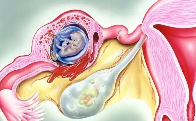 慢性輸卵管炎會影響懷孕嗎 慢性輸卵管炎治療方法 慢性輸卵管炎會影響懷孕嗎 慢性輸卵管炎治療方法