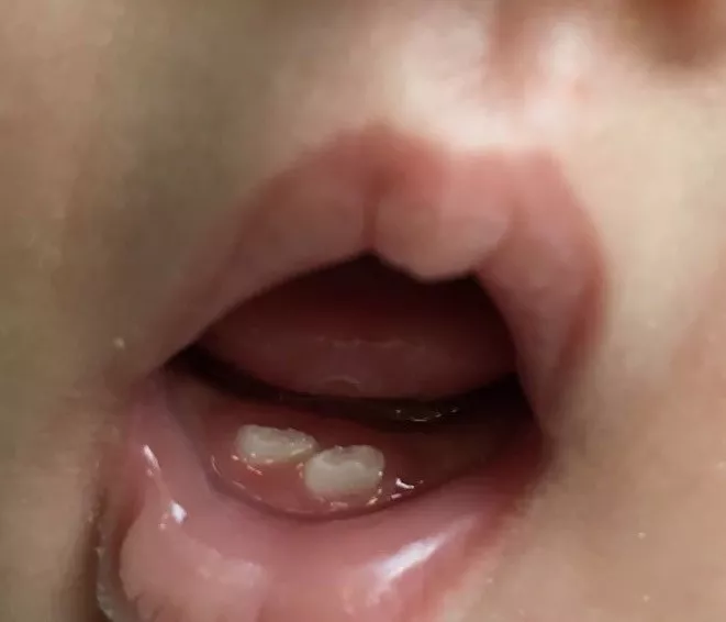 吃母乳會得齲齒是真的嗎 孩子母乳需要早點斷奶放齲齒嗎