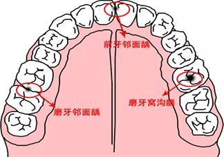 孩子有齲齒是什么原因導致的 孩子發齲病的主要原因是什么