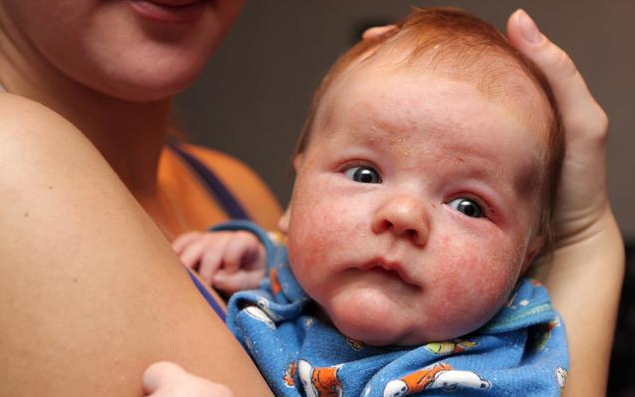 寶寶濕疹可以洗澡嗎 寶寶起濕疹洗澡需要注意什么