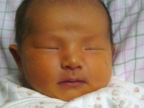 新生兒黃疸多久能退 新生兒黃疸怎么護理