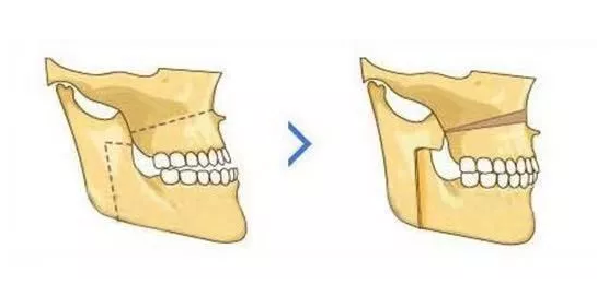 孩子乳牙反頜幾歲矯正最好 孩子乳牙反頜矯正時間