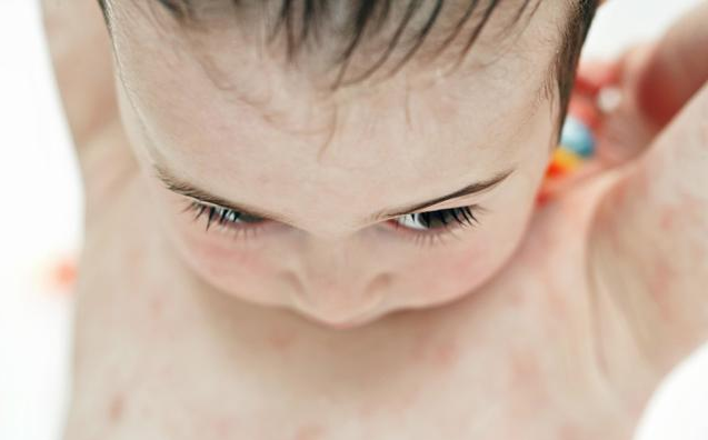 寶寶濕疹反復不好是什么原因 寶寶濕疹反復不好怎么辦