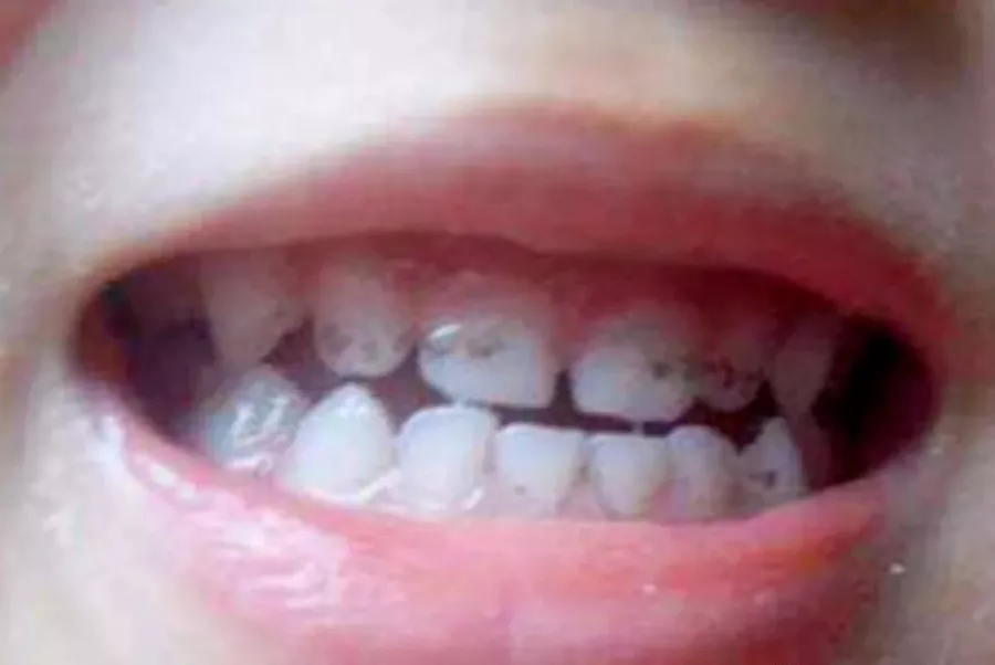 孩子牙齒上的黑斑是什么 孩子牙齒有黑斑是齲齒嗎