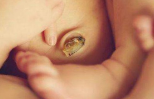 寶寶臍帶痂什么時候脫落 臍帶脫落后怎么護理