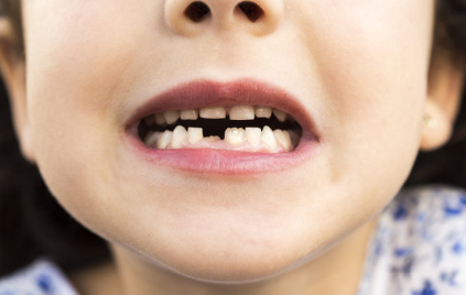 孩子長了雙排牙怎么辦 孩子雙排牙能拔嗎 孩子長了雙排牙怎么辦 孩子雙排牙能拔嗎