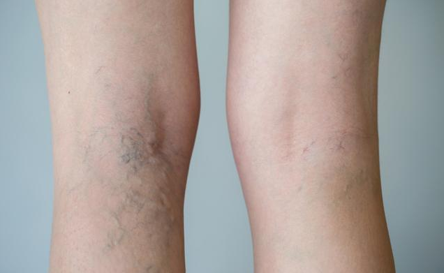 靜脈曲張的早期癥狀 孕媽出現靜脈曲張怎么辦