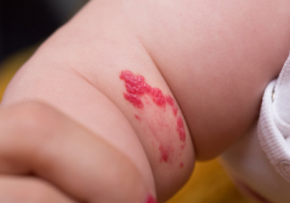 如何預(yù)防生出胎記寶寶 這幾點原因要了解清楚了