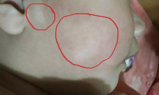 孩子臉上有白斑是積食還是蟲斑 孩子臉上有白斑原因有哪些