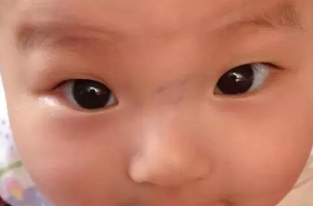 寶寶鼻梁上有青筋比較難養嗎 孩子鼻梁上方有青筋怎么回事