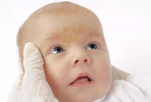 春季寶寶濕疹高峰期 寶寶濕疹護理方法 春季寶寶濕疹高峰期 寶寶濕疹護理方法