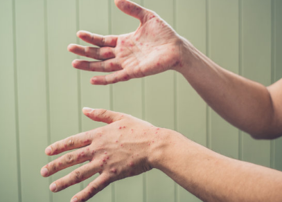 春季手足口病如何預防  平時如何做好手足口病的預防工作