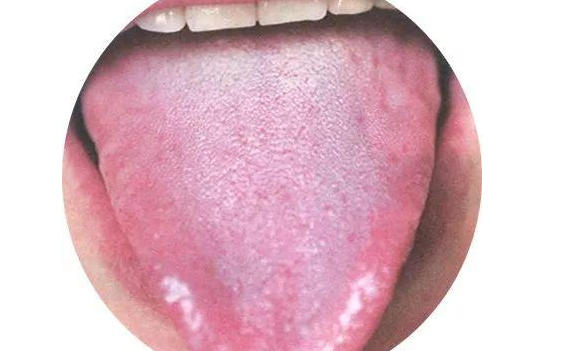 小兒草莓舌是什么 孩子草莓舌是身體有什么異常嗎 小兒草莓舌是什么 孩子草莓舌是身體有什么異常嗎