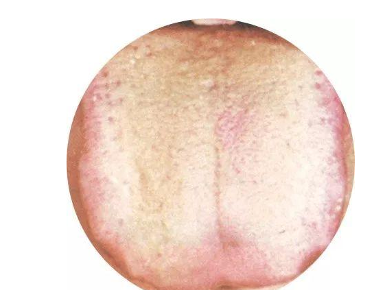 小兒草莓舌是什么 孩子草莓舌是身體有什么異常嗎 小兒草莓舌是什么 孩子草莓舌是身體有什么異常嗎