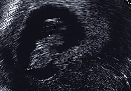 子宮內膜增厚是什么原因 子宮內膜增厚的原因