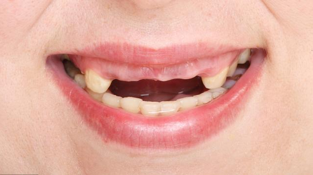 缺牙太久就不能種植牙了嗎 缺牙后如何補救