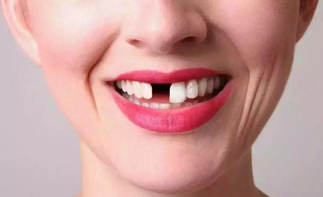 缺牙太久就不能種植牙了嗎 缺牙后如何補救