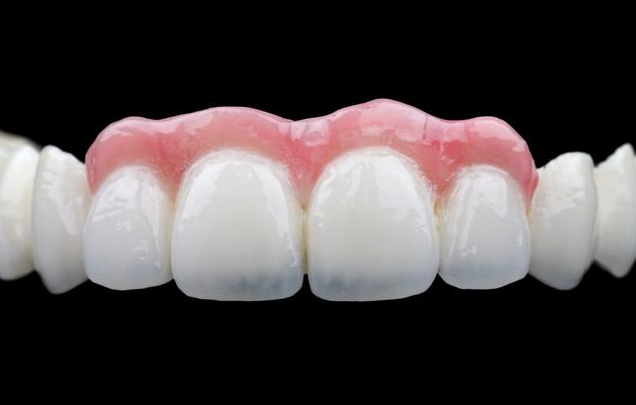 缺牙太久就不能種植牙了嗎 缺牙后如何補救