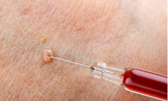 臉上長扁平疣是宮頸癌嗎 臉上有太多扁平疣怎么辦