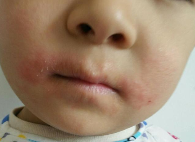 寶寶爛嘴角是上火了嗎 寶寶爛嘴角怎么辦