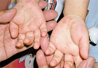 孩子春季容易得哪些傳染病 孩子春季傳染病如何簡單護理