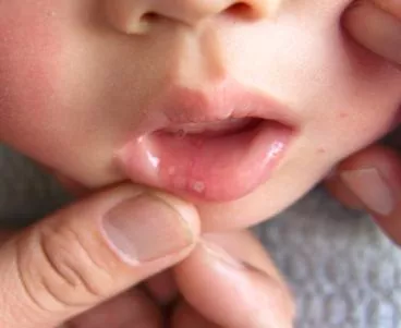 孩子為什么會(huì)長(zhǎng)出馬牙 孩子長(zhǎng)馬牙的原因是什么 孩子為什么會(huì)長(zhǎng)出馬牙 孩子長(zhǎng)馬牙的原因是什么