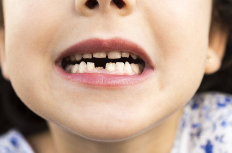 孩子長雙排牙是怎么回事 孩子長了雙排牙該怎么辦