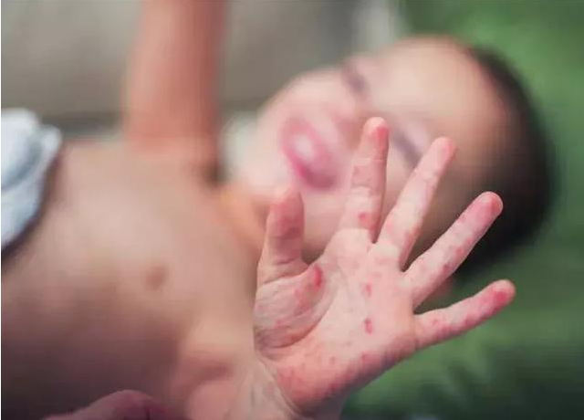 美國麻疹疫情爆發 麻疹疫苗接種注意事項 美國麻疹疫情爆發 麻疹疫苗接種注意事項