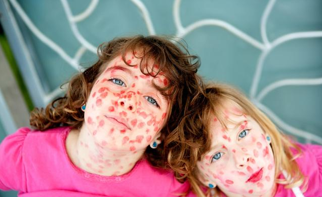 如何區(qū)別幼兒急疹與麻疹 小兒麻疹會引發(fā)哪些并發(fā)癥