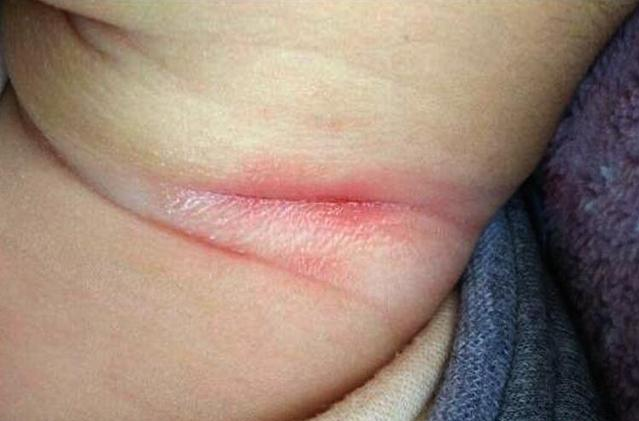 寶寶淹脖子可以用爽身粉嗎 寶寶淹脖子怎么做好得快