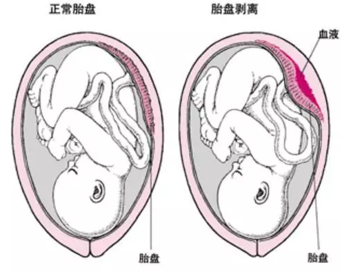 胎盤早剝前期有哪些征兆 胎盤早剝的原因是什么