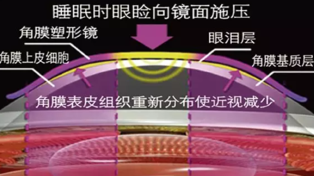 角膜塑形鏡孩子可以戴嗎 角膜塑形鏡多大孩子能帶