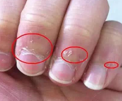 寶寶手上為何老長“這種東西”  孩子經(jīng)常長倒刺該怎么辦