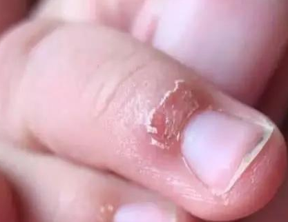 寶寶手上為何老長“這種東西”  孩子經(jīng)常長倒刺該怎么辦