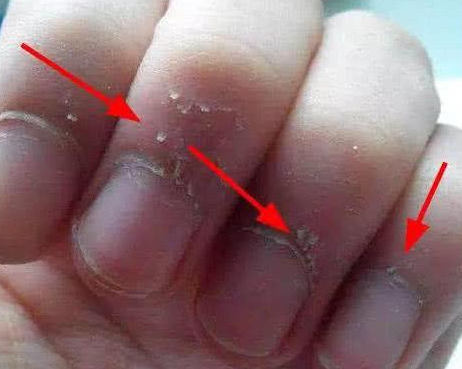 寶寶手上為何老長“這種東西”  孩子經(jīng)常長倒刺該怎么辦