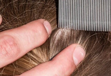 孩子頭發上好多白點點什么東西 為什么會產生頭虱子