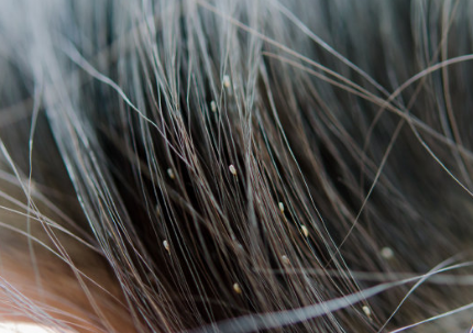 孩子頭發上好多白點點什么東西 為什么會產生頭虱子