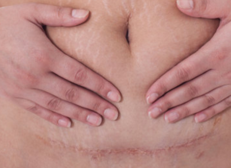 疤痕體質的孕婦剖腹產是怎樣的體驗 疤痕體質有多可怕