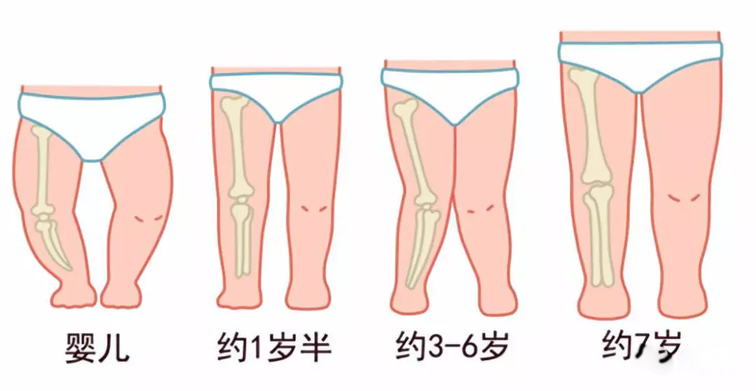 孩子腿外翻需要綁腿嗎 給孩子綁腿會不會有什么影響