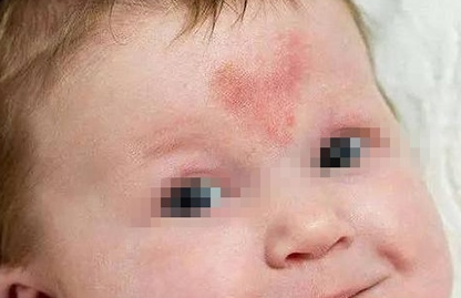 預防寶寶長胎記的方法 新生兒有胎記的原因