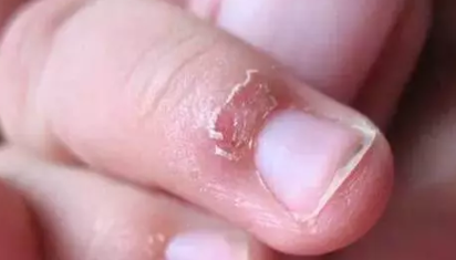 寶寶指甲相關問題匯總 倒刺/月牙/白點/豎紋問題