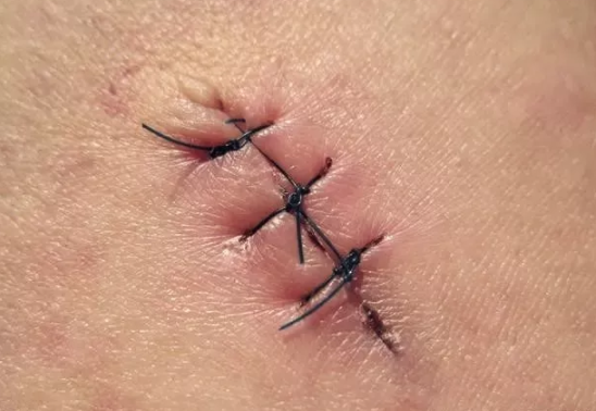 順產撕裂和側切有什么不同 順產撕裂和側切的區別