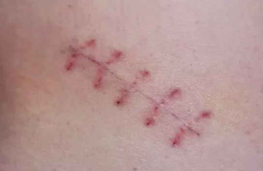 順產(chǎn)撕裂傷口怎么護理 順產(chǎn)撕裂傷口護理方法