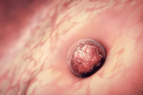 試管嬰兒移植后出血正常嗎 試管嬰兒移植后出血嚴重嗎