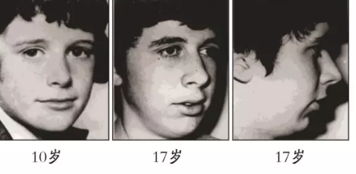 用口呼吸會對顏值有影響嗎 為什么用嘴呼吸會變丑