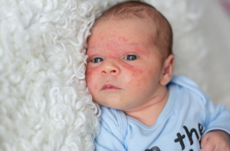 寶寶濕疹可以打疫苗嗎 哪些情況是寶寶不合適打疫苗