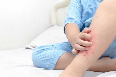 為何蚊蟲愛叮咬小孩子  孩子被蚊子咬了該怎么辦