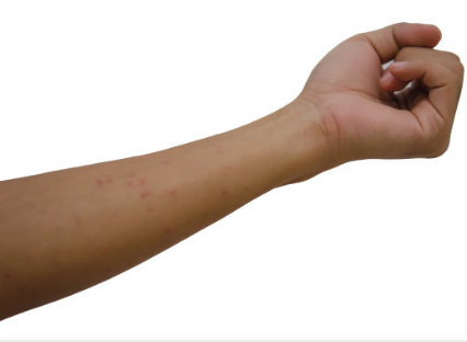 為何蚊蟲愛叮咬小孩子  孩子被蚊子咬了該怎么辦