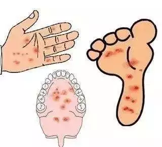 手足口病預防有用嗎 孩子學校有人得了手足口病要如何避免他也得