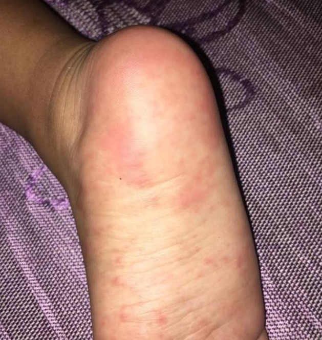 手足口病會引起哪些并發癥 如何照顧手足口病的患兒 手足口病會引起哪些并發癥 如何照顧手足口病的患兒